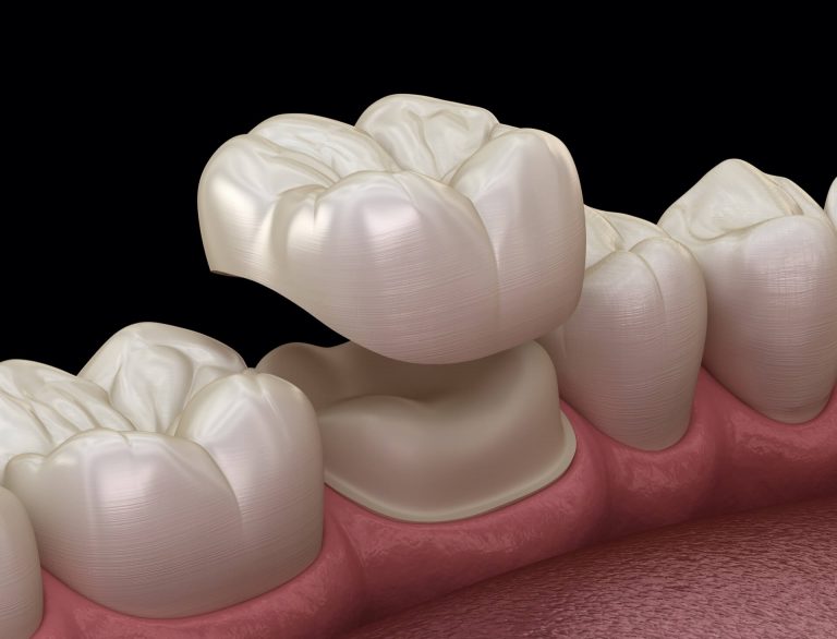 Dental Crowns 1920 768x586 