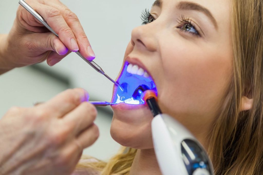 Dental Fillings in Colorado Springs