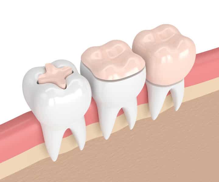 Digital rendering of teeth