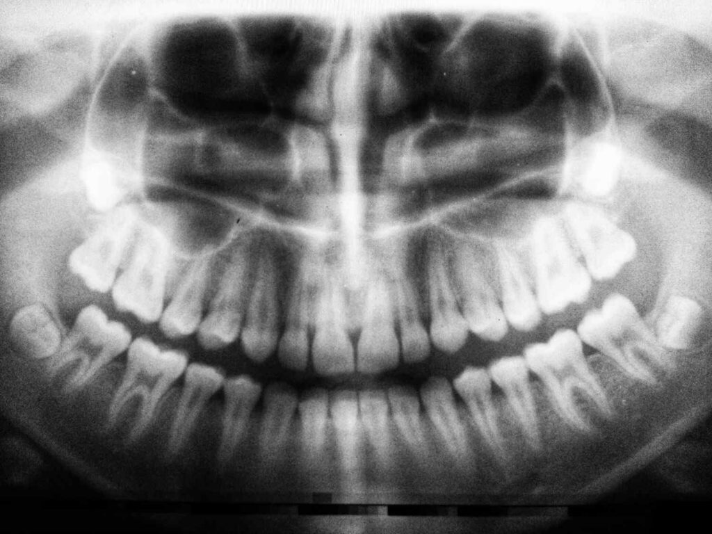 Wisdom Teeth Answered