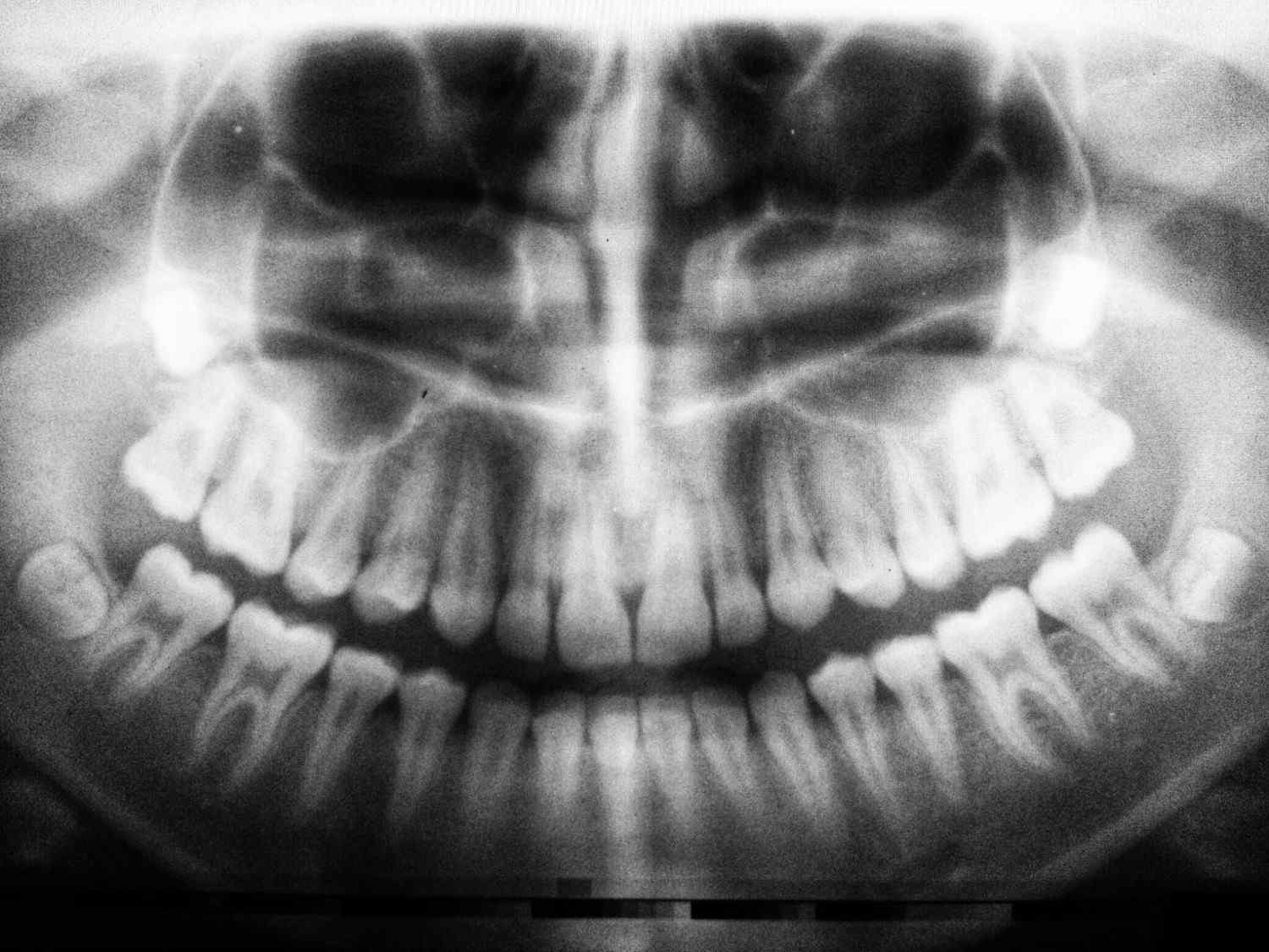 Wisdom Teeth Answered