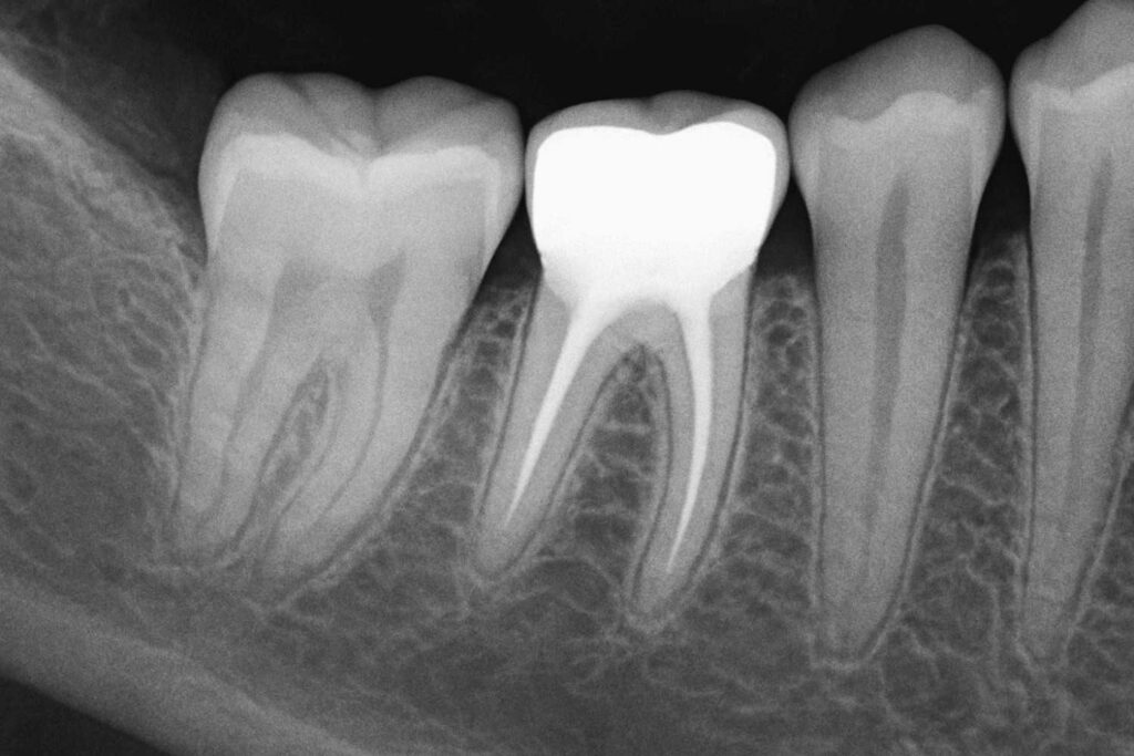 radiopaque in dentistry