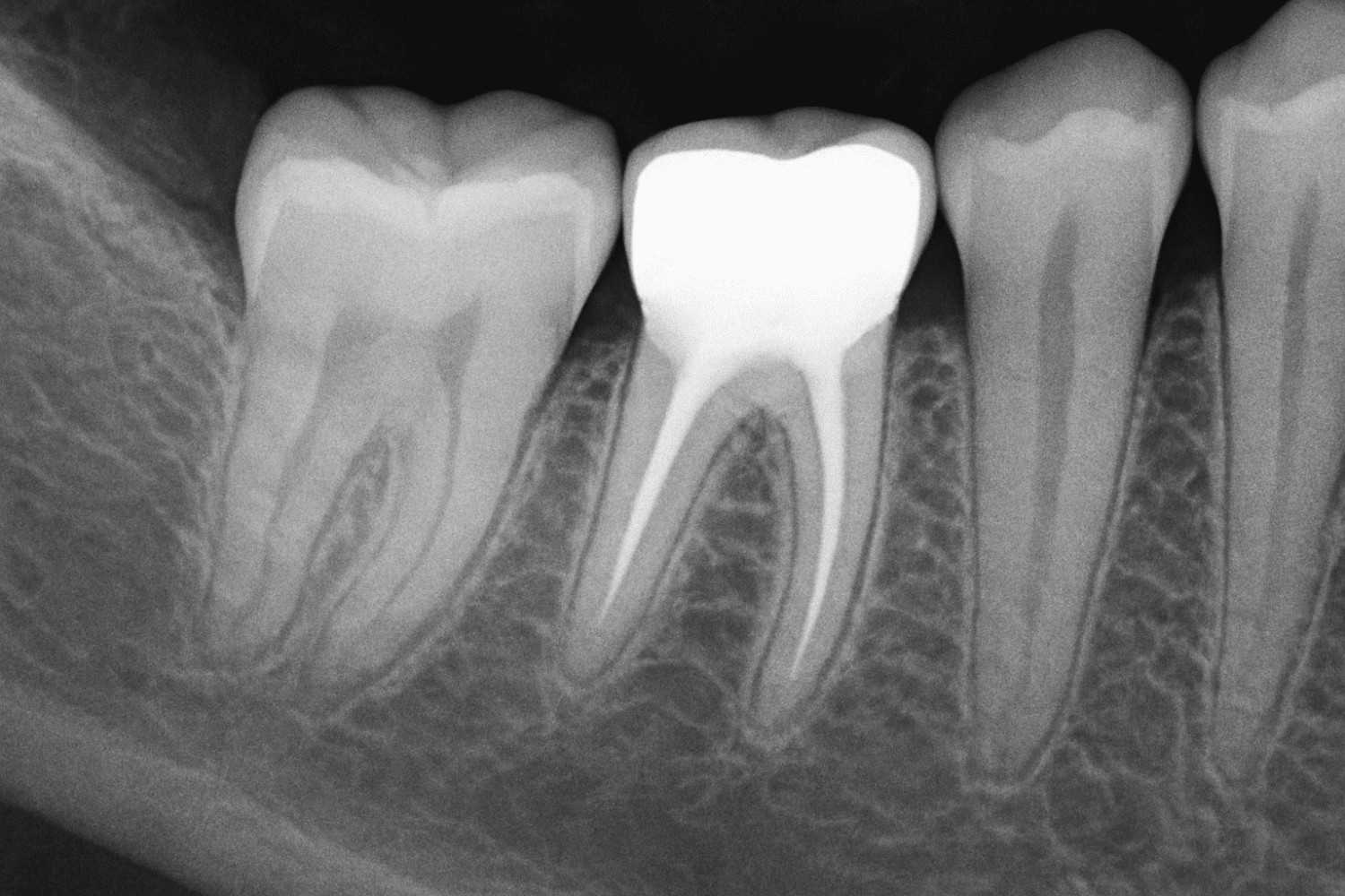 radiopaque in dentistry