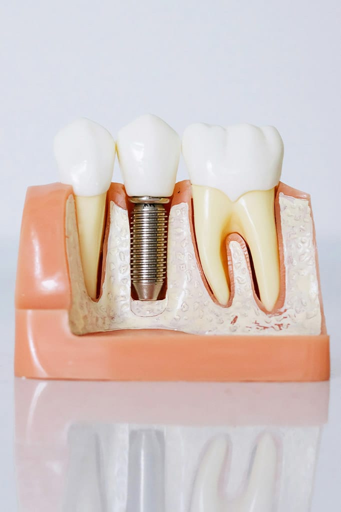 Dental Implants