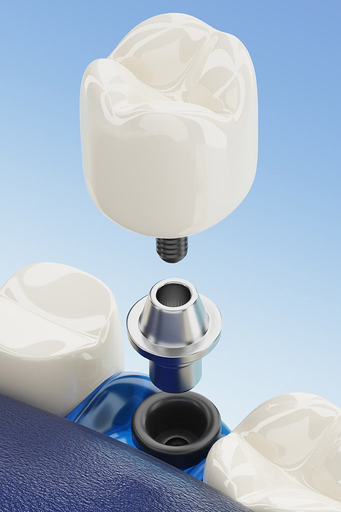 dental implants 2