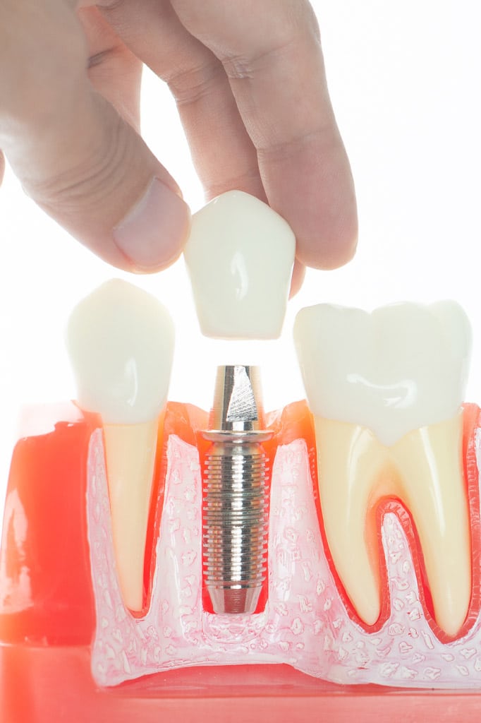 dental implants 3