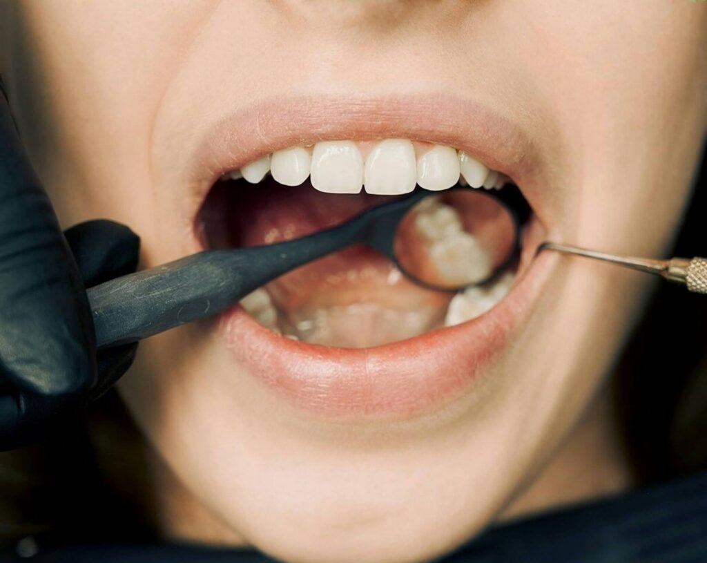 dental crowns