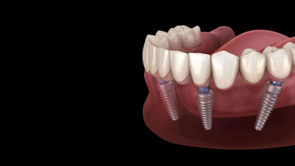 Illustration of dental implants placed in the jawbone showing titanium posts supporting artificial teeth for tooth replacement
