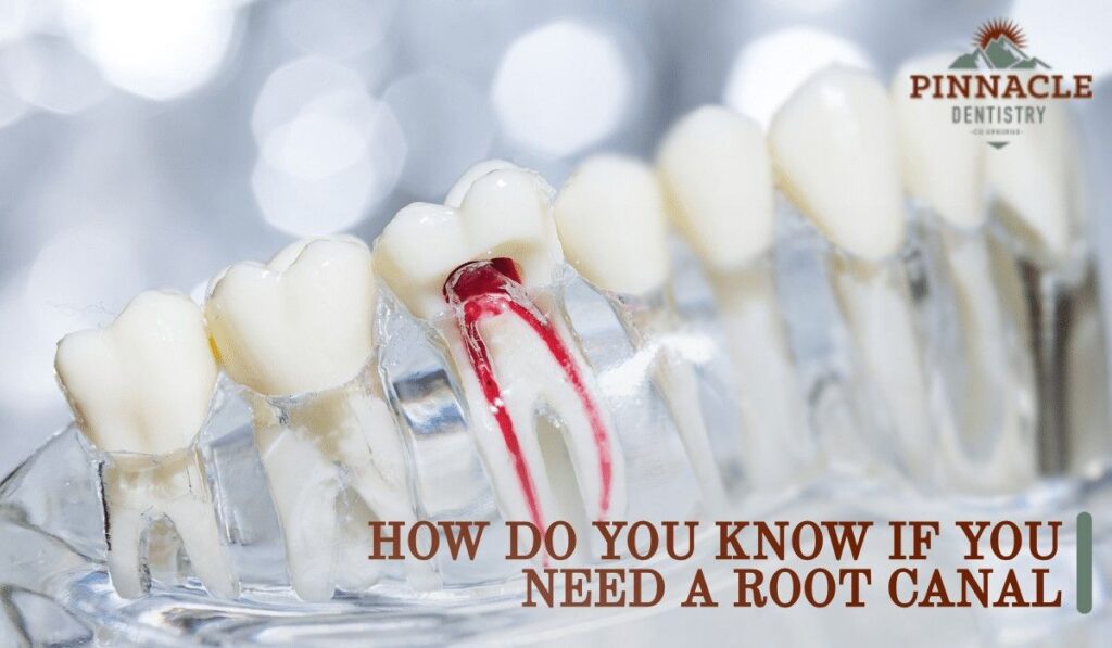 root canal Process