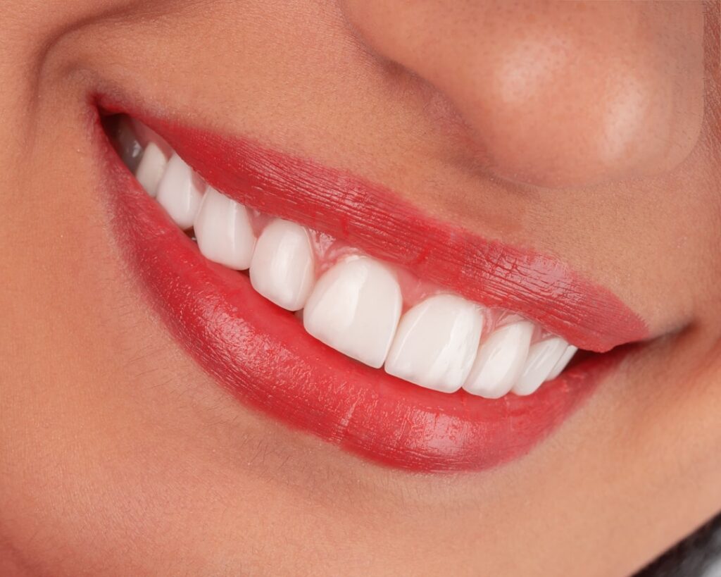 what is the average cost of porcelain veneers