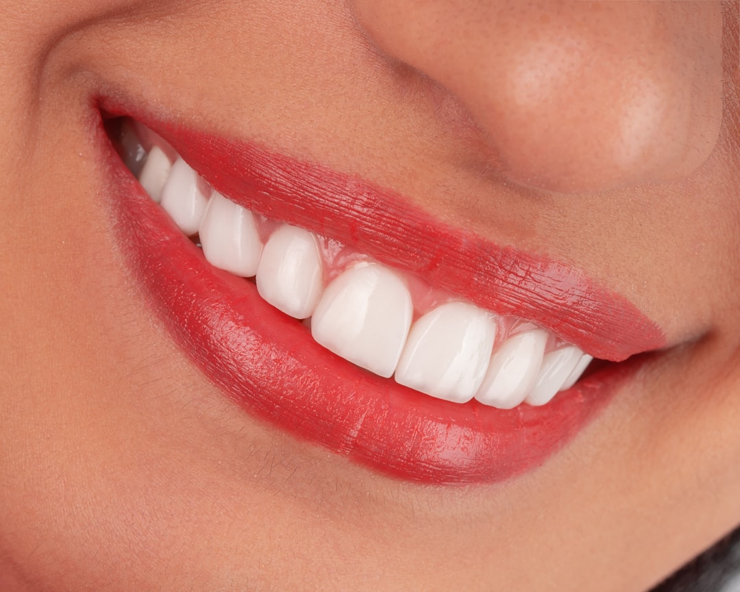 what is the average cost of porcelain veneers