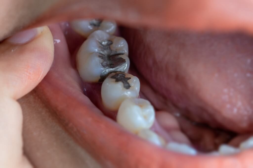 filled tooth sensitive to cold